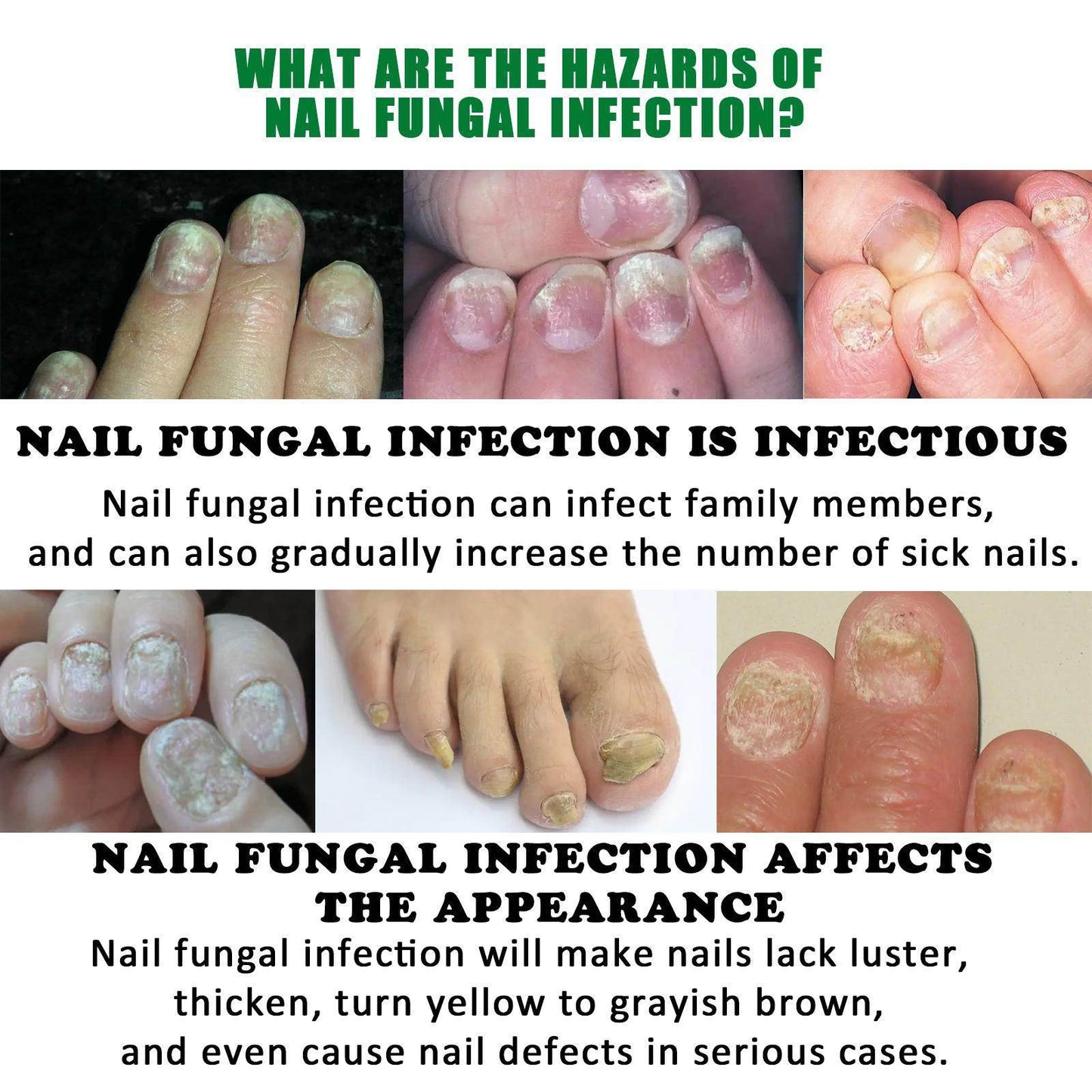 Jiasuying Ginger Nail Care Liquid, Repairs And Moisturizes Hand And Foot Nails, Makes Nails Shiny And Soft, And Improves Onychomycosis - Velora