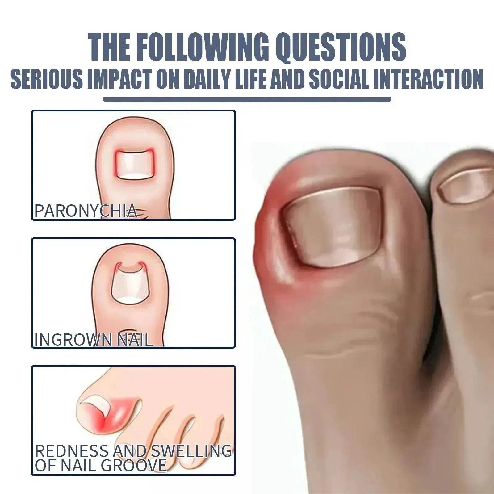 Relieving And Repairing Ingrown Nail Toe Nail Removing Meat Treatment Oil - Velora