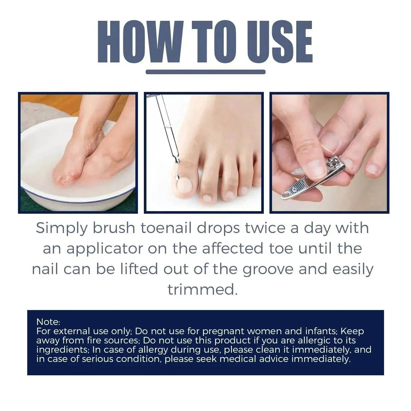Relieving And Repairing Ingrown Nail Toe Nail Removing Meat Treatment Oil - Velora
