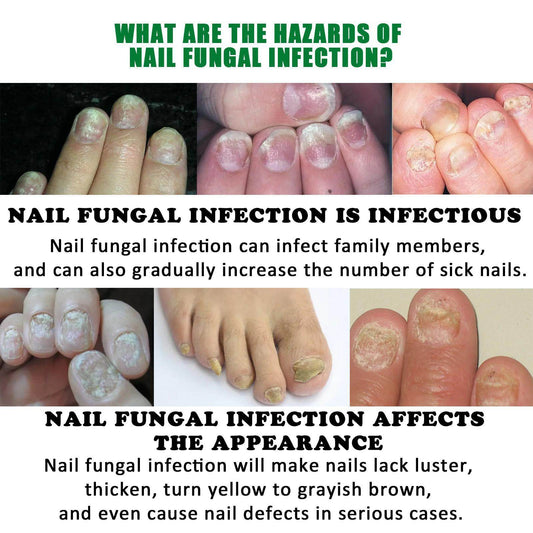 Jiasuying Ginger Nail Care Liquid, Repairs And Moisturizes Hand And Foot Nails, Makes Nails Shiny And Soft, And Improves Onychomycosis - Velora