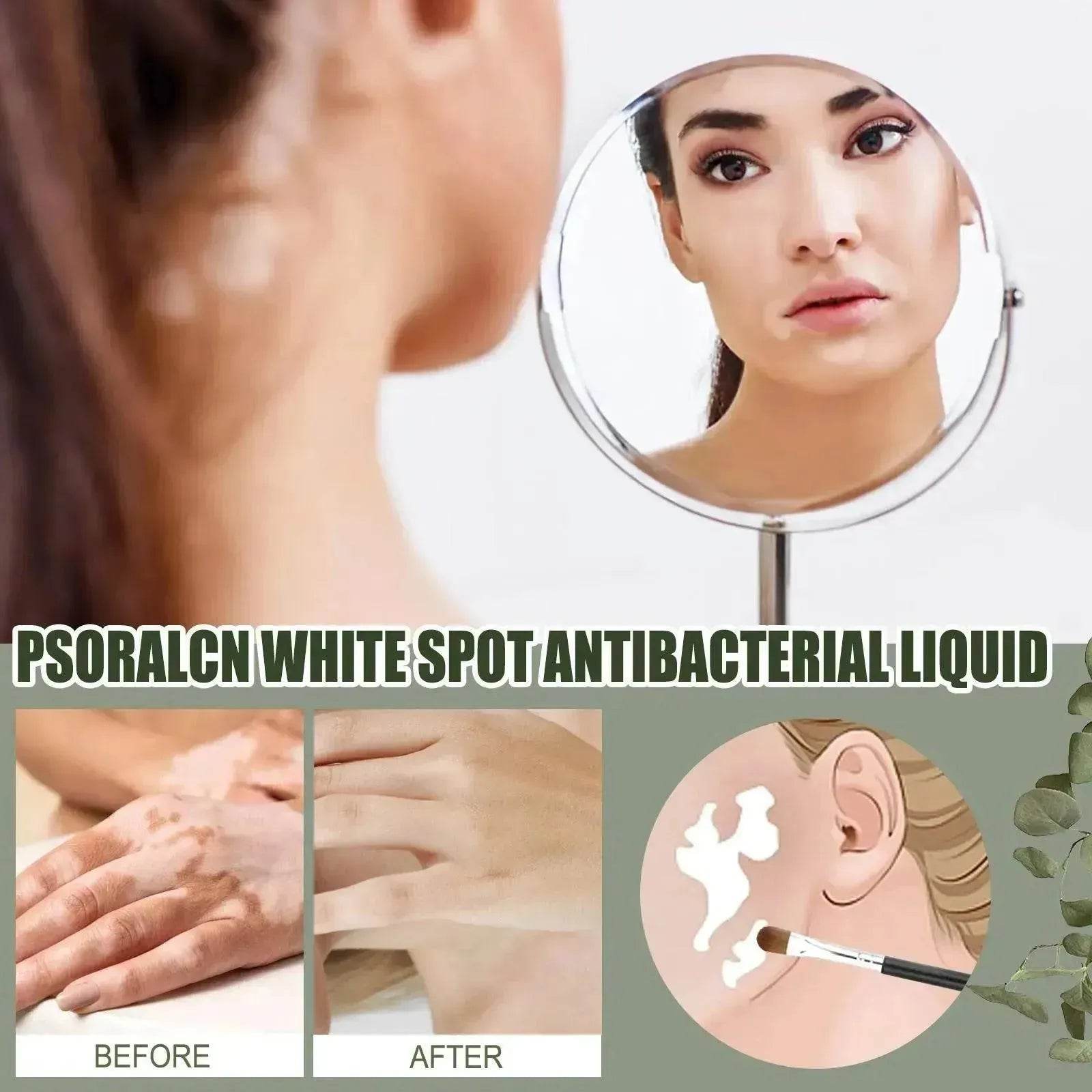 EELHOE White Spot Cleansing Serum PSORALCN White Spot Antibacterial Liquid. - Velora