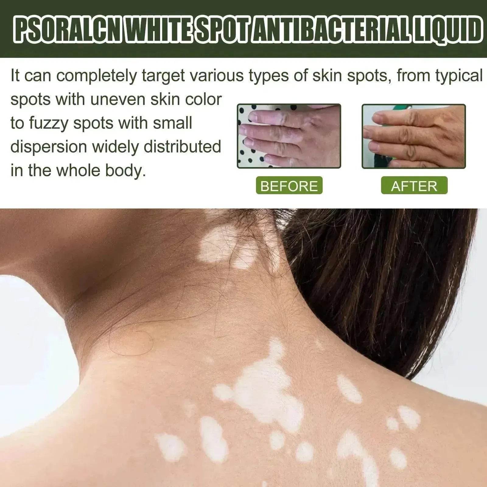 EELHOE White Spot Cleansing Serum PSORALCN White Spot Antibacterial Liquid. - Velora