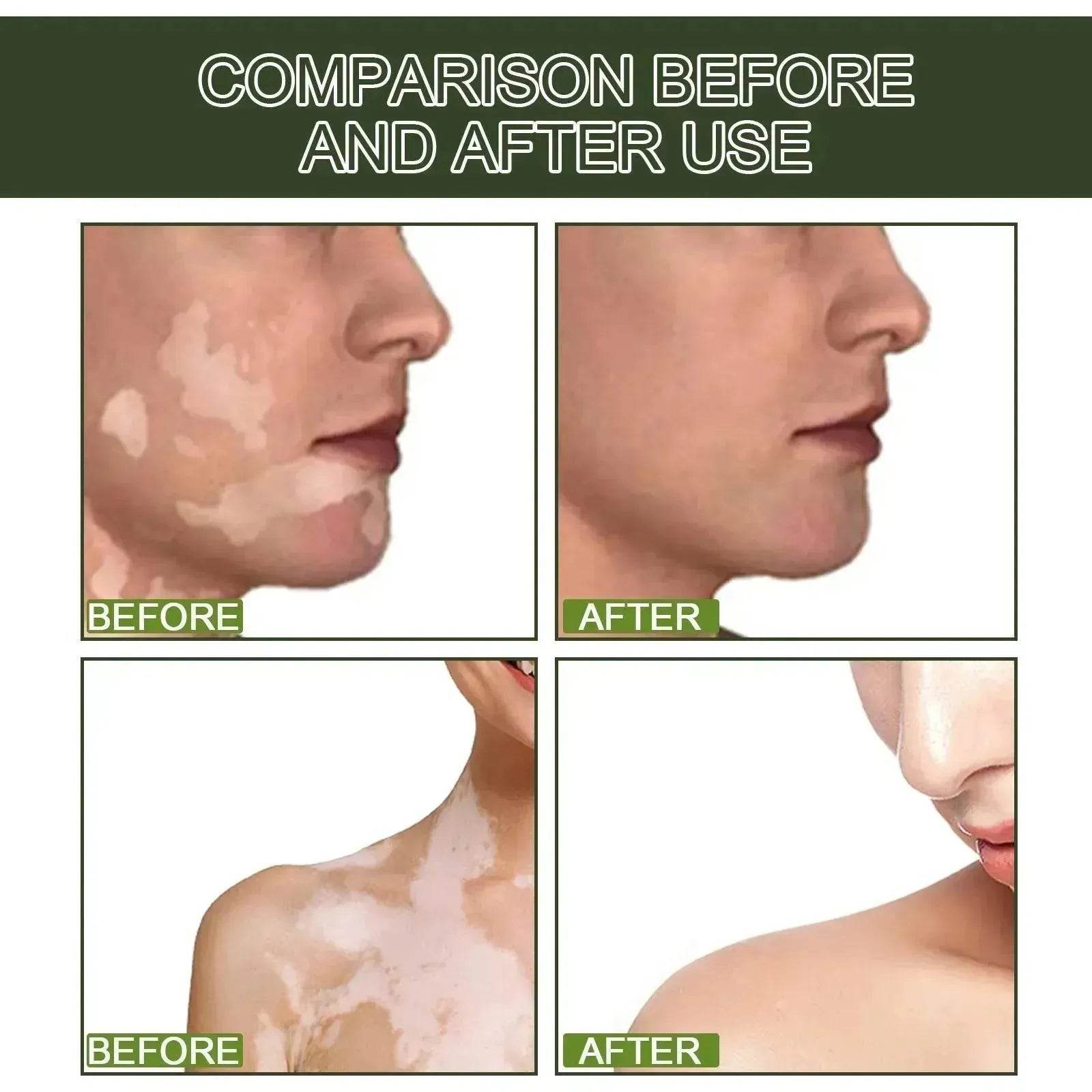 EELHOE White Spot Cleansing Serum PSORALCN White Spot Antibacterial Liquid. - Velora